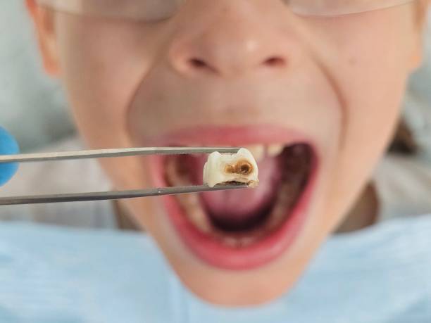 Best Broken or Cracked Tooth Emergency Dentist in Eming Island, FL
